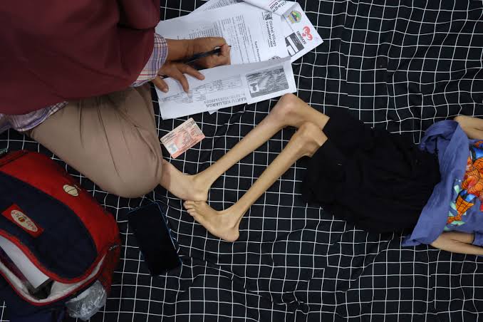 Viral! Diagnosis Usus Buntu RI vs Malaysia, Kemenkes Akhirnya Buka Suara